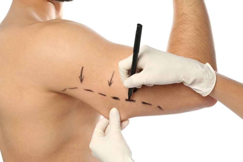 Doctor,Drawing,Marks,On,Man's,Arm,For,Cosmetic,Surgery,Operation