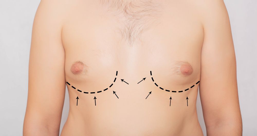 Male,Body,,Male,Breast,Plastic,,Gynecomastia.,Male,Breast,Adjustment,,Plastic
