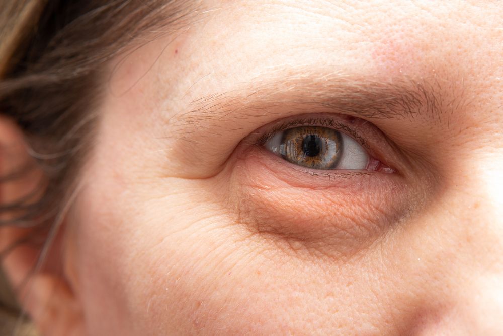 Closeup,Of,Wrinkles,And,Heavy,Puffiness,In,The,Eye,Region