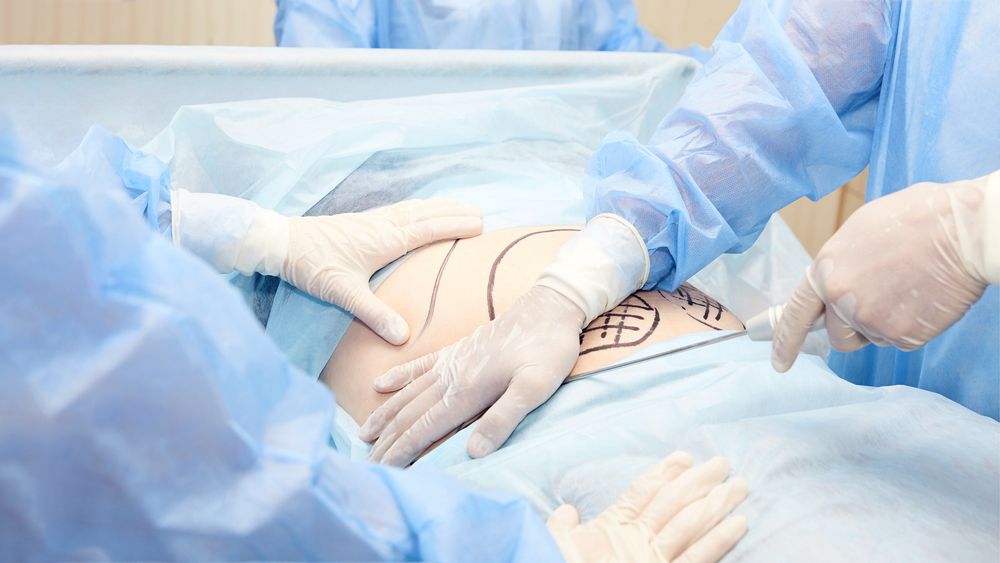 Surgery,Room.,Belly,Surgery.,Doctor,Mark,Liposuction,Area,At,Tummy.