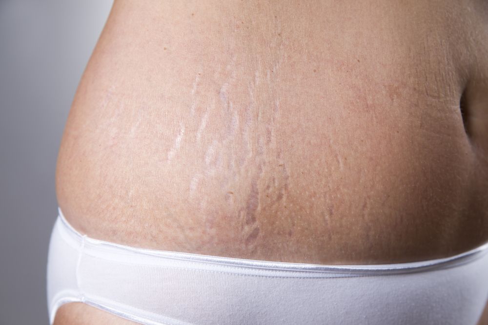 Female,Belly,With,Stretch,Marks,Closeup,On,A,Gray,Background