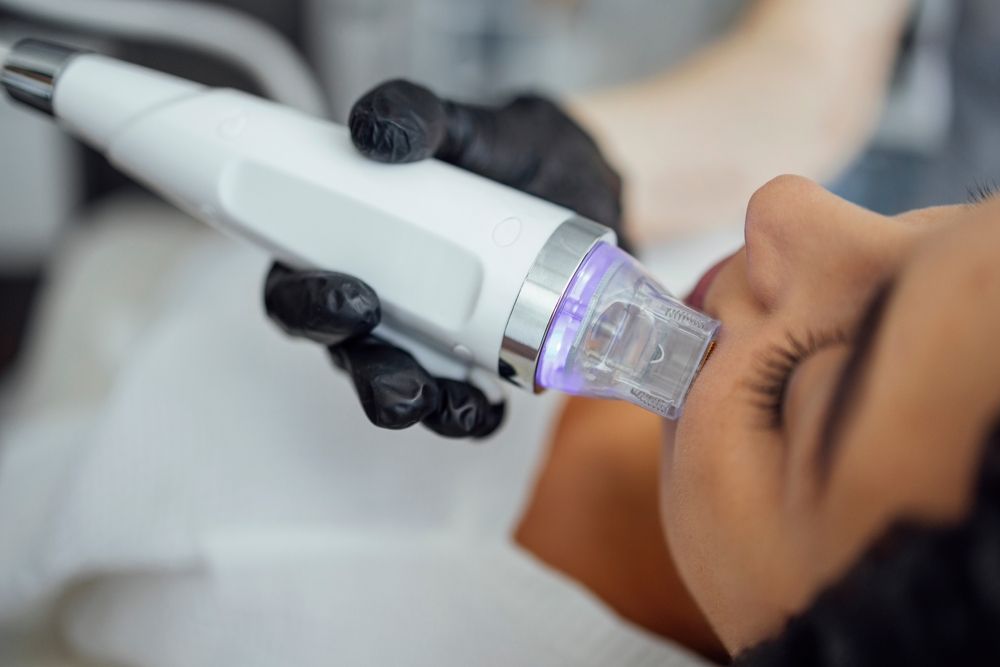 Microneedle,Rf,Lifting,Procedure.,Hardware,Cosmetology.,Beautician,Conducts,A,Facial