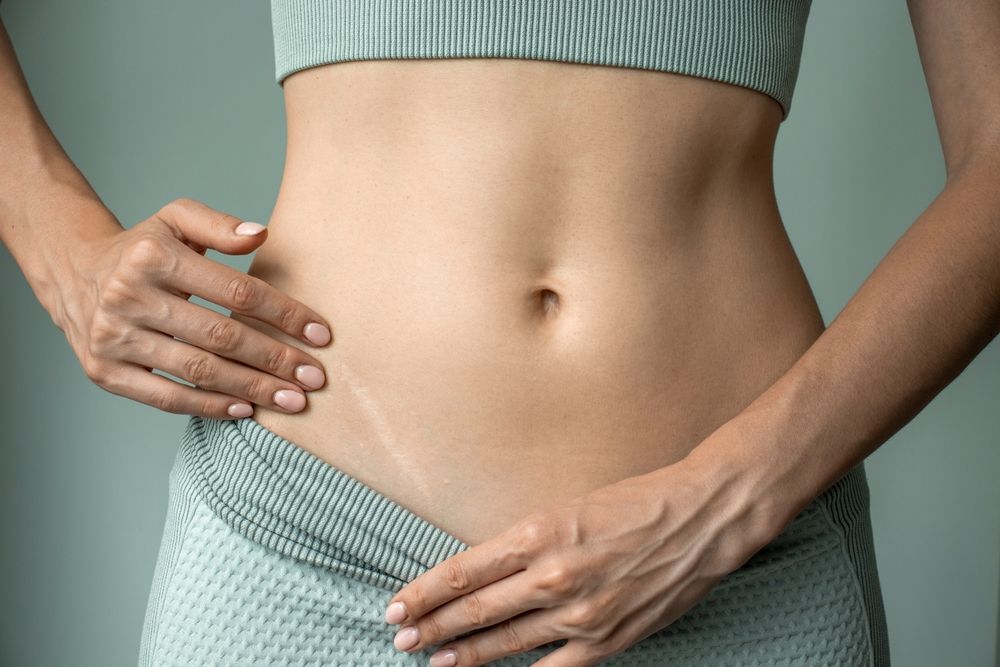 A,Woman,Shows,A,Scar,From,Appendicitis,On,Her,Stomach