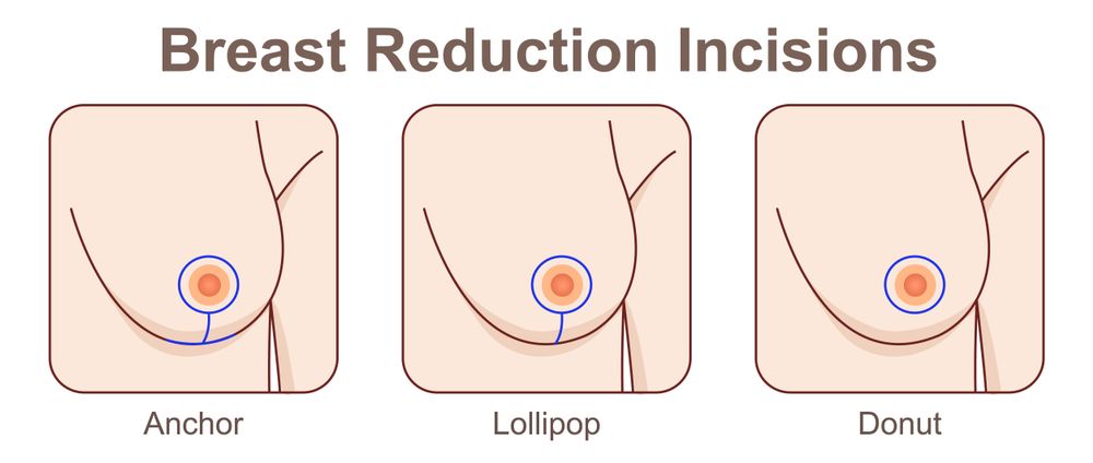 Breast,Reduction,Incisions