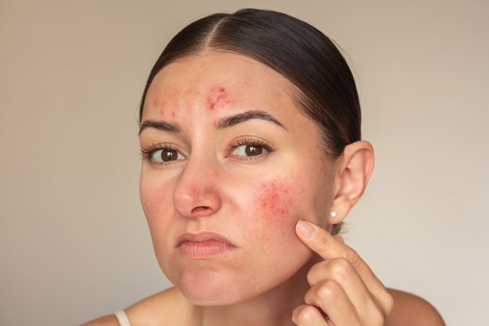 Young,Brunette,Caucasian,Woman,Examines,The,Pimples,On,Her,Face.