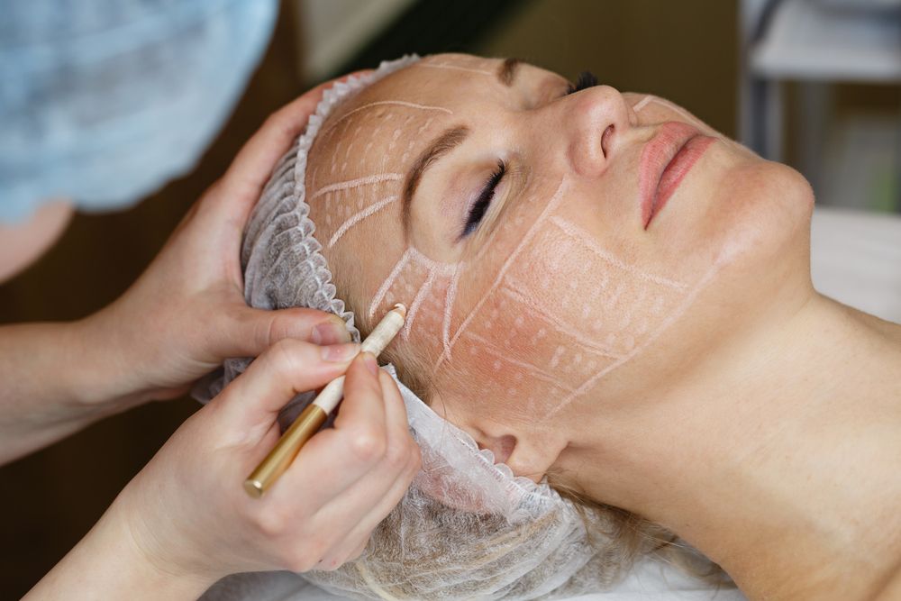 Non-surgical,Face,Lifting.,Smas,Lifting,Ultrasonic.,Facelift.
