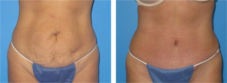 Abdominoplasty before and after treatment
