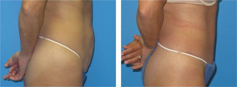 Abdominoplasty before and after treatment
