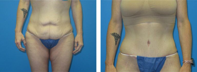 Abdominoplasty before and after treatment