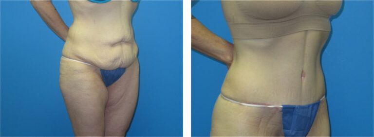 Abdominoplasty before and after treatment