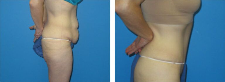 Abdominoplasty before and after treatment