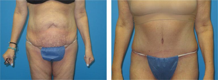 Abdominoplasty before and after treatment