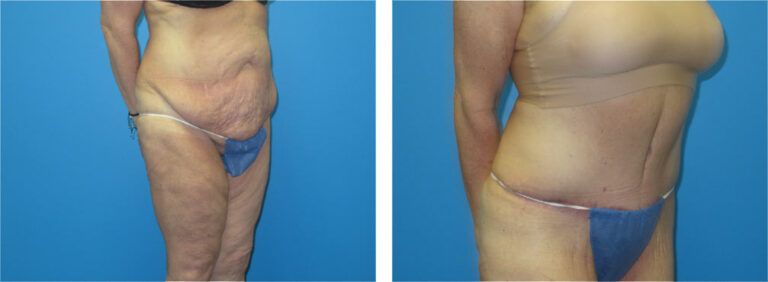 Abdominoplasty before and after treatment
