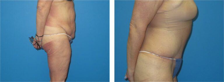 Abdominoplasty before and after treatment