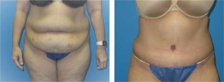 Abdominoplasty before and after treatment