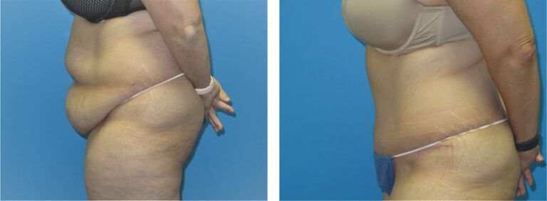 Abdominoplasty before and after treatment