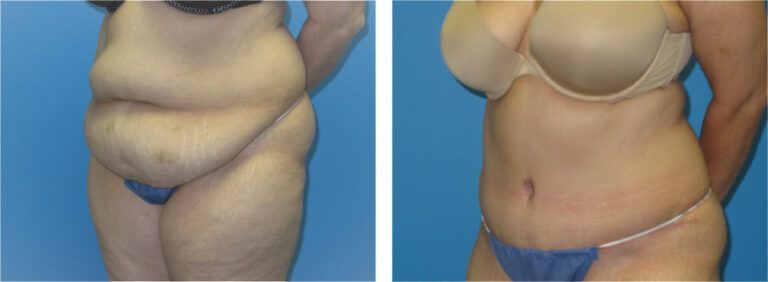 Abdominoplasty before and after treatment