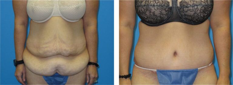 Abdominoplasty before and after treatment