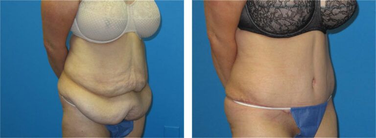 Abdominoplasty before and after treatment