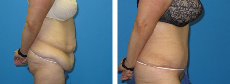 Abdominoplasty before and after treatment