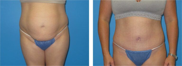 Abdominoplasty before and after treatment