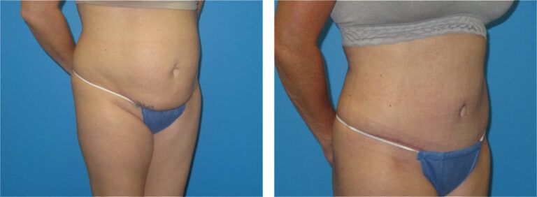 Abdominoplasty before and after treatment