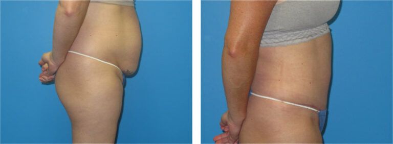 Abdominoplasty before and after treatment