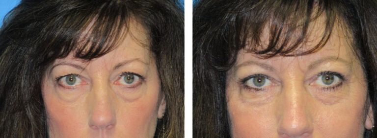 Blepharoplasty before and after treatment