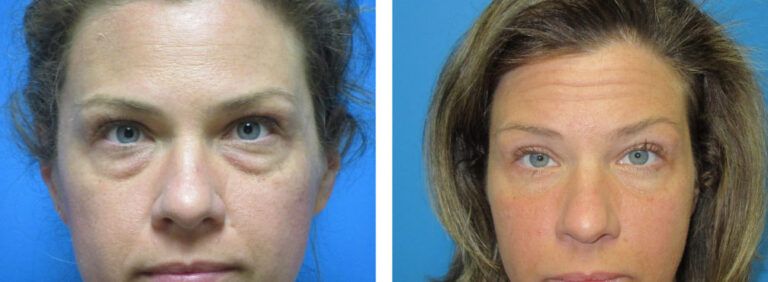 Blepharoplasty before and after treatment