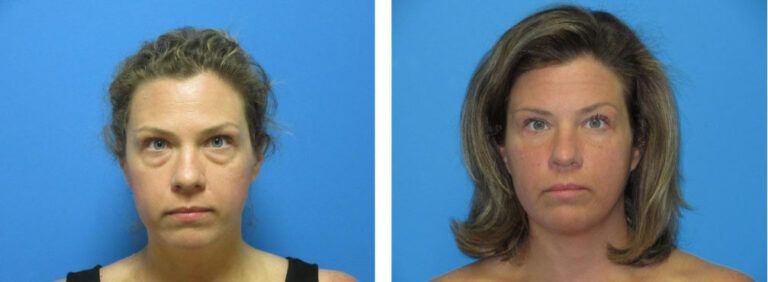 Blepharoplasty before and after treatment