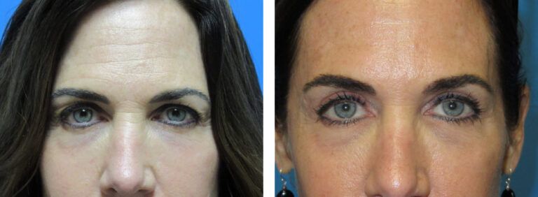 Blepharoplasty before and after treatment