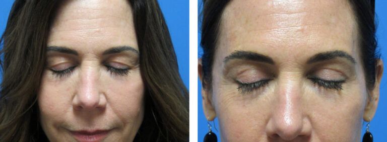 Blepharoplasty before and after treatment