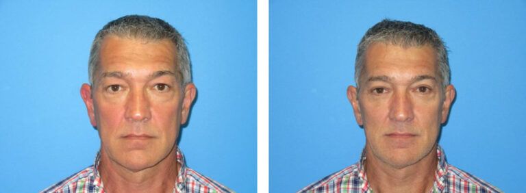 Blepharoplasty before and after treatment