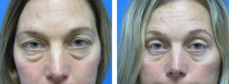 Blepharoplasty before and after treatment