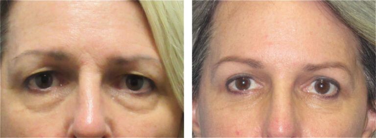 Blepharoplasty before and after treatment