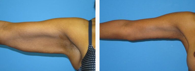 Brachioplasty before and after treatment