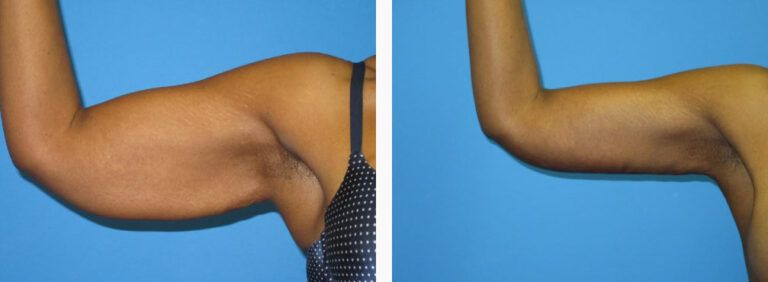 Brachioplasty before and after treatment