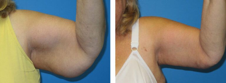 Brachioplasty before and after treatment