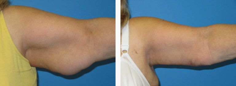 Brachioplasty before and after treatment