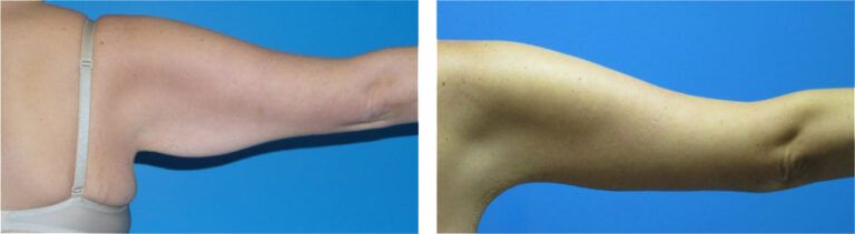 Brachioplasty before and after treatment