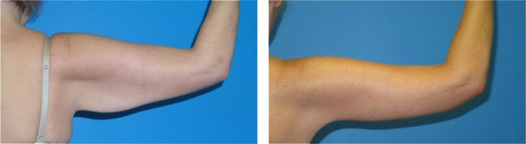 Brachioplasty before and after treatment