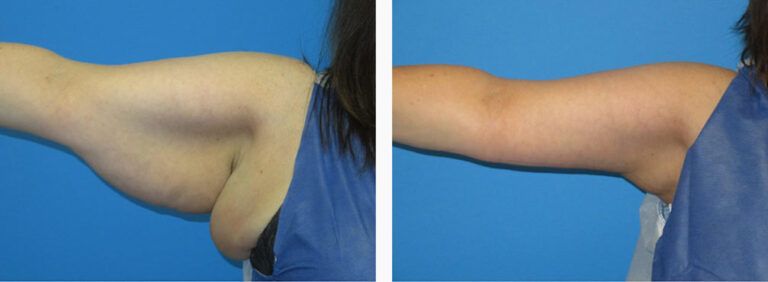 Brachioplasty before and after treatment
