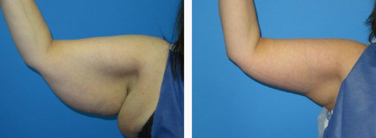 Brachioplasty before and after treatment