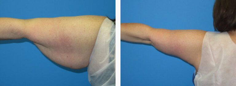 Brachioplasty before and after treatment