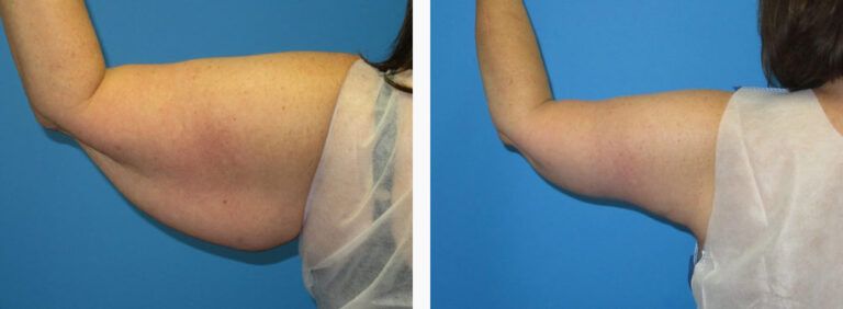 Brachioplasty before and after treatment