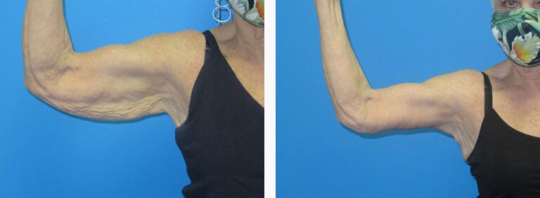 Brachioplasty before and after treatment