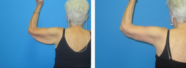 Brachioplasty before and after treatment