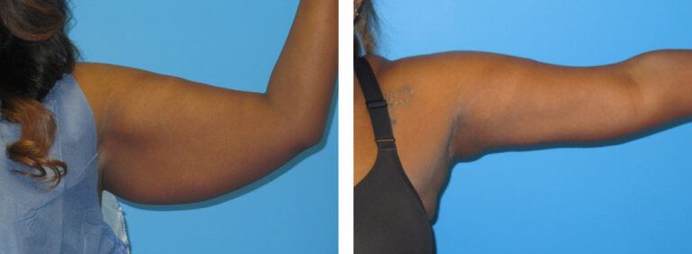 Brachioplasty before and after treatment