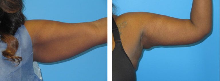 Brachioplasty before and after treatment