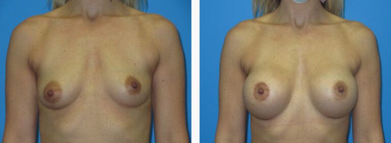 Breast Augmentation before and after treatment